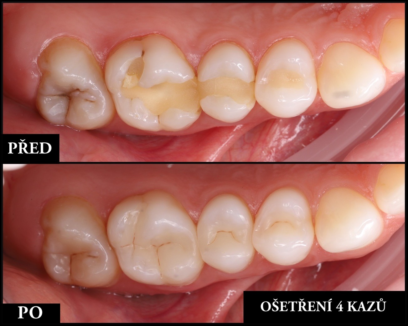 Profesionální zubní ošetření v ordinaci DENTALIST - ošetření bez bolesti s mikroskopem